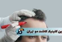 بهترین مرکز کاشت مو در تهران